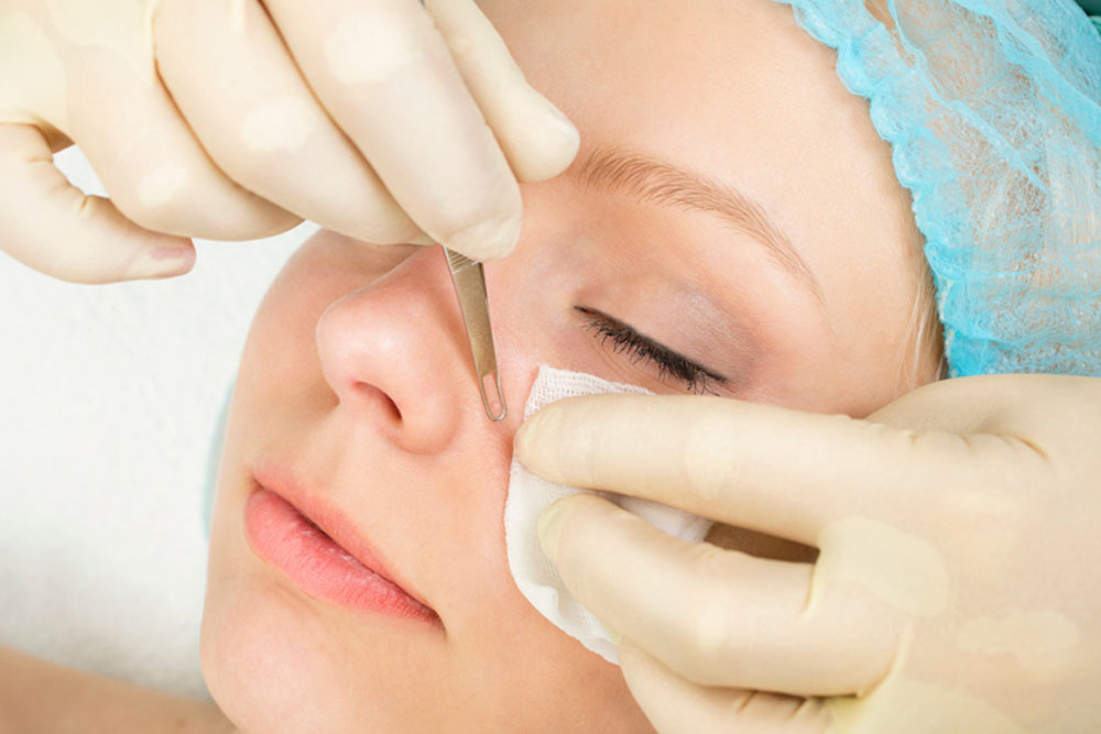 6 SIMPLE & EASY TIPS TO PREVENT BLACKHEADS