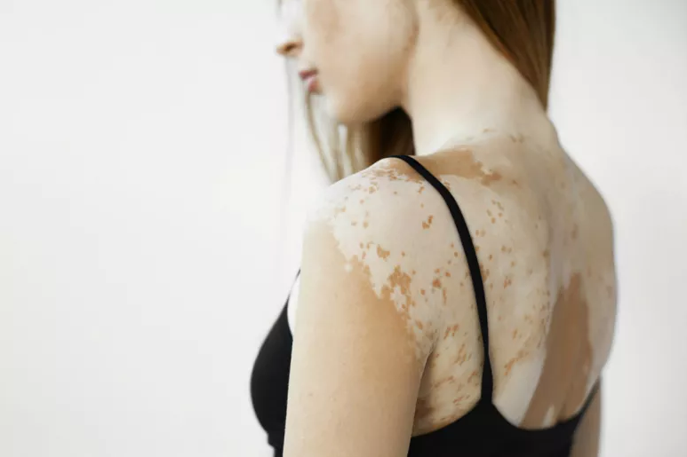 Everything You Need To Know about Vitiligo